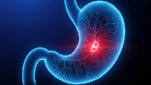 Difference Between a Stomach Ulcer and Cancer